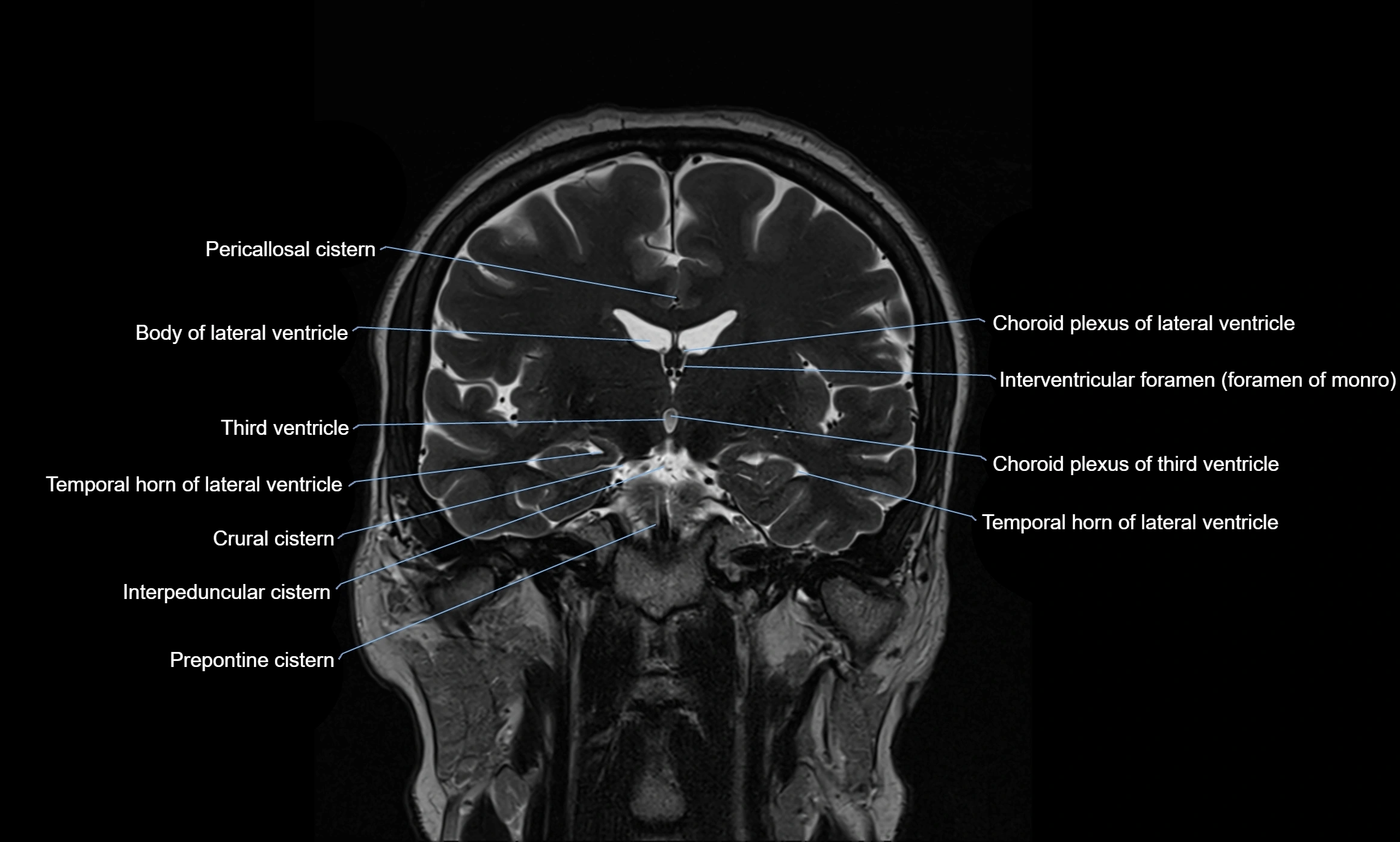 Brain cisterns  and ventricles coronal anatomy 3T MRI image-img-00001-00028.webp